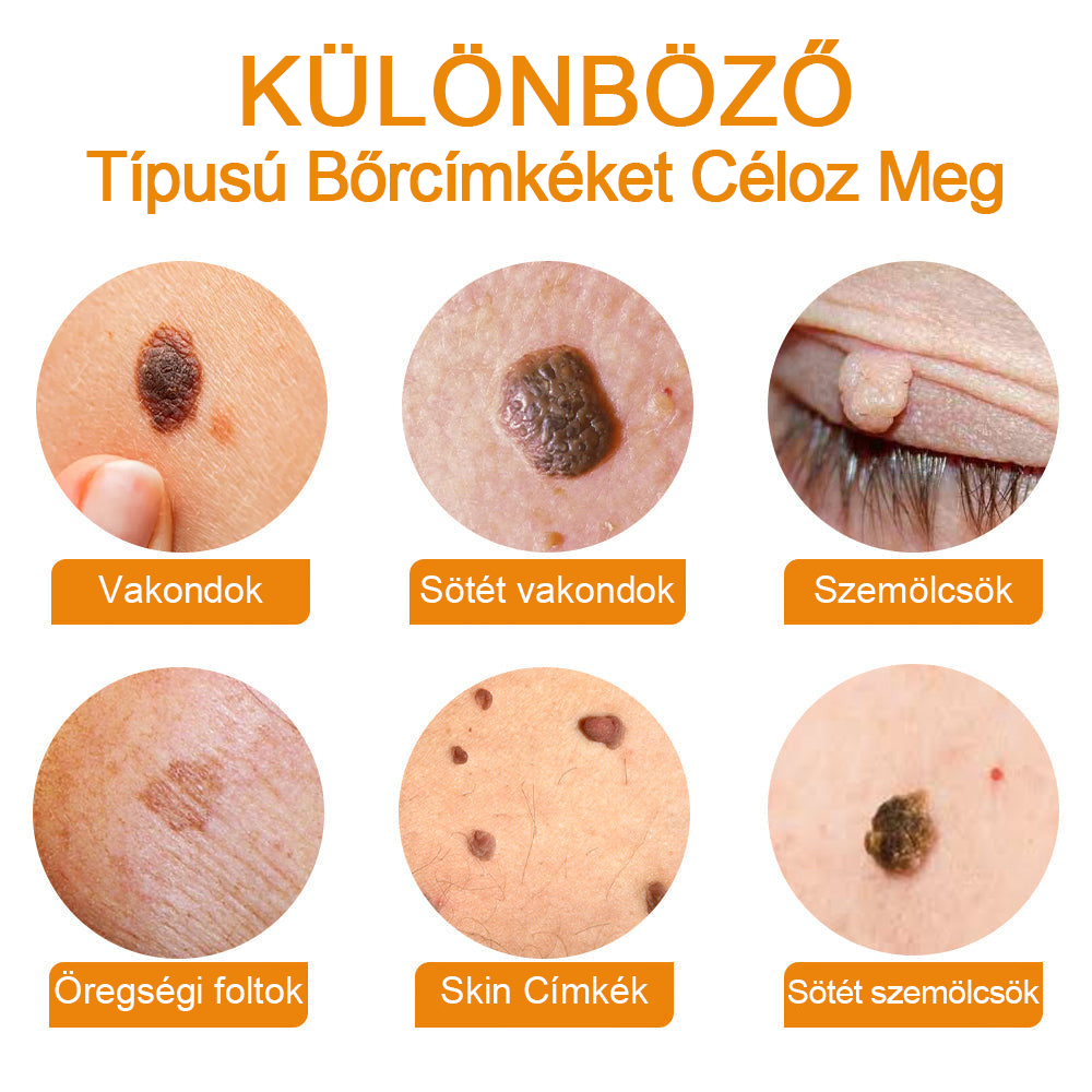 🍃🐝TURONU™ méhméreg szemölcs és anyajegy eltávolító krém (Utolsó napi akció, 80% kedvezmény)